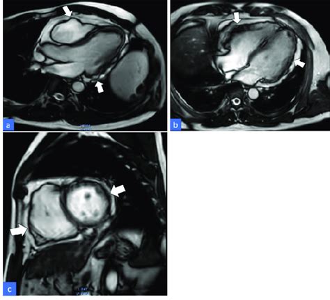 Cardiac Magnetic Resonance Cmr Bright Blood Images Three Chamber View