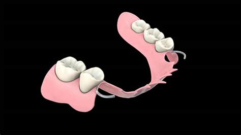 Stayplate Temporary Partial Denture Patient Education | MediaMed