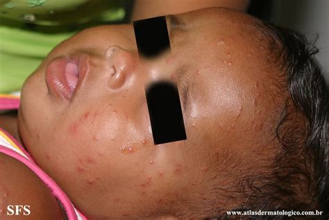 Acrodermatitis Infantile Papular Nc Commons