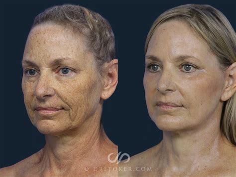 Deep Plane Facelift Neck Lift Traceless Before And After Pictures