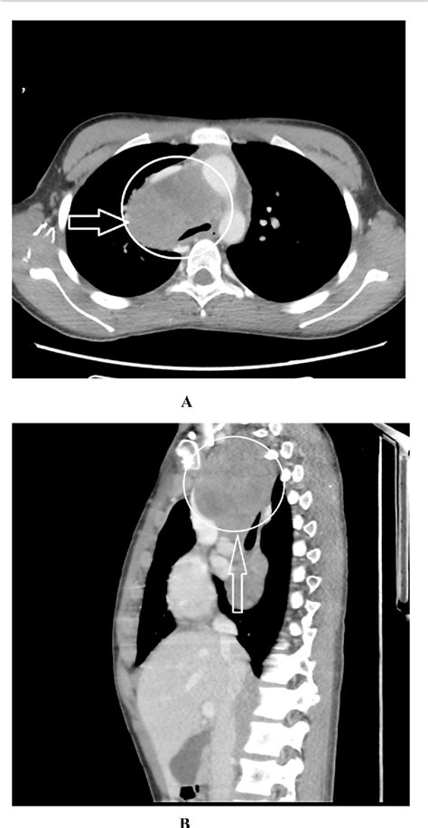 Figure 3 From A Rare Case Of The Superior Vena Cava Obstruction In A 16