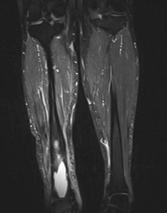 MRI Appearances Of Chronic Osteomyelitis Of The Right Distal Tibia