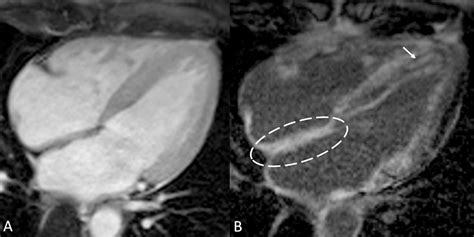 Scielo Brasil Cardiac Magnetic Resonance And Amyloidosis Review