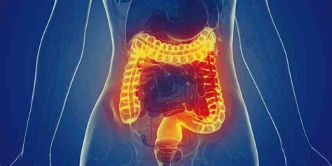 Diverticulitis causas síntomas tratamiento y prevención Remedios