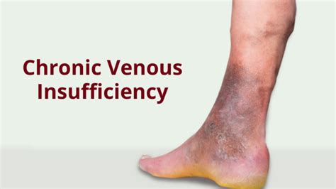 Venous Insufficiency Venous Ulcers Pneumatic Compression Off