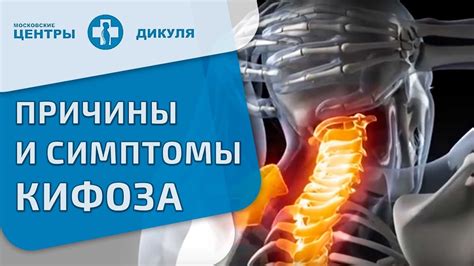 Кифоз грудного отдела позвоночника (грудной кифоз)