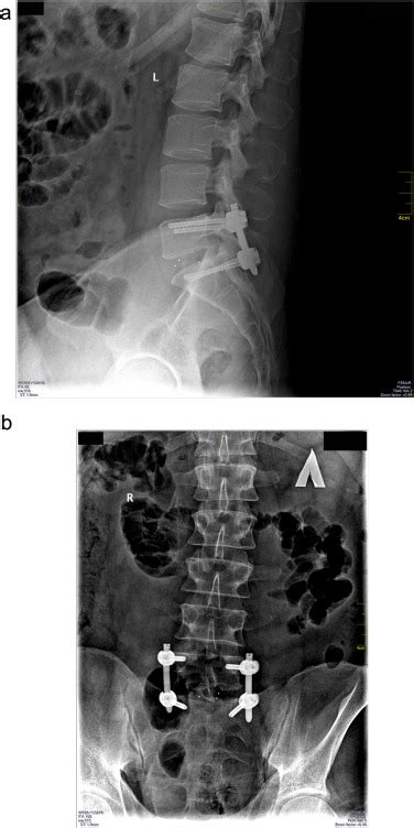 X Rays Of The Lumbar Spine In The Anteroposterior A And Lateral B