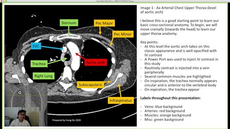 Basic CT CAP Cross Sectional Anatomy YouTube