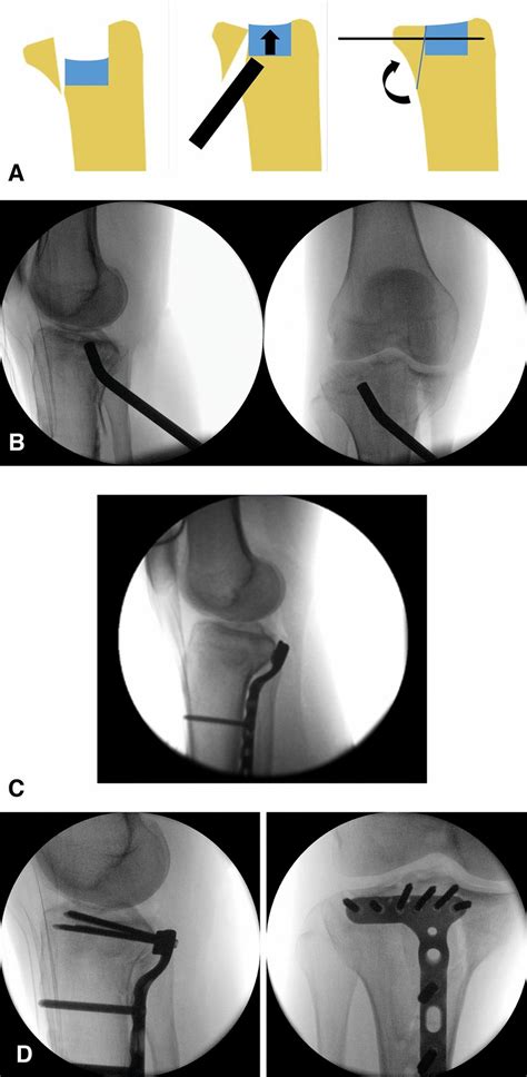 Indirect Reduction Technique And Wave Posterior Proximal Tibia Plate