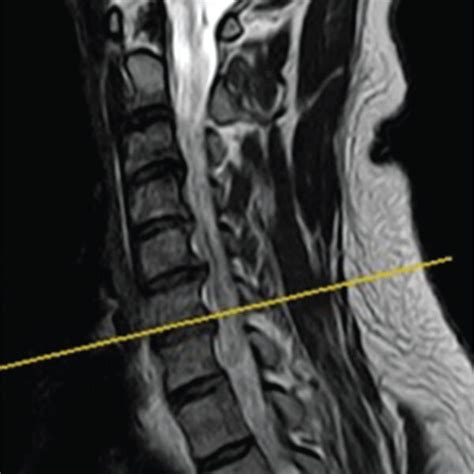 Cervical Intervertebral Foraminal Stenosis At C6 7 Level The Download Scientific Diagram