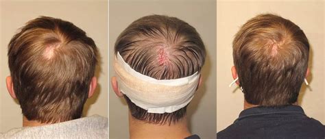 Transplanting Hair Into A Scar What You Need To Know Htandrc