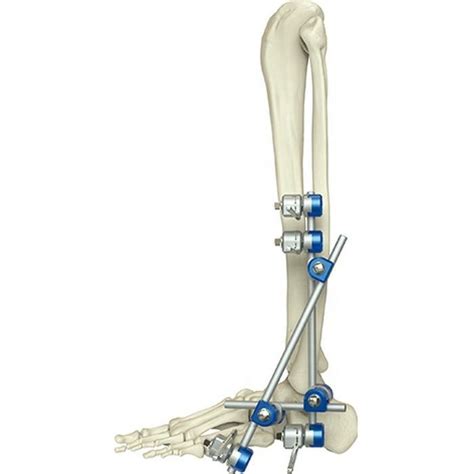 Medical Orthopedic Instrument Ankle External Fixation Device