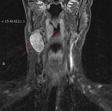 Visible Lymph Nodes In Neck