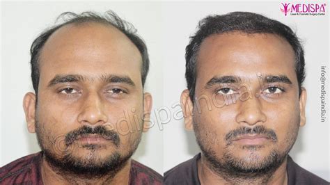 Hair Transplant In Gujarat India Hair Transplant Dubai Cost