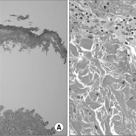 A The Epidermis Of Skin Biopsy Shows Subepidermal Blister Formation Download Scientific