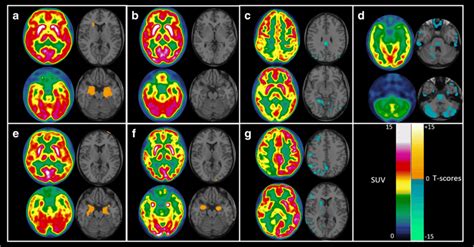 Image gallery of axial brain ¹⁸F FDG PET representative of the typical