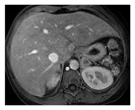 Autosplenectomy Is Found In A Patient With Homozygous Sickle Cell