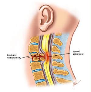 Neurogenic shock: Causes, Symptoms, Diagnosis & Treatment