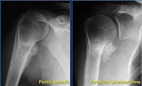 The Radiology Assistant : Bone - Sclerotic tumors and tumor-like lesions