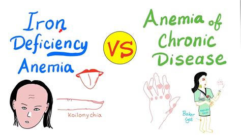 Iron Deficiency Anemia Ida Vs Anemia Of Chronic Disease Acd Youtube