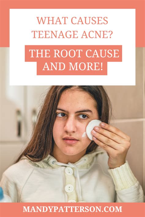 What Causes Teenage Acne The Root Cause And More Mandy Patterson