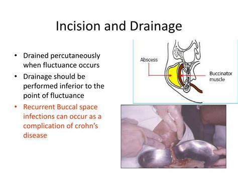 Ppt Complex Odontogenic Infections Powerpoint Presentation Free Download Id 1944812