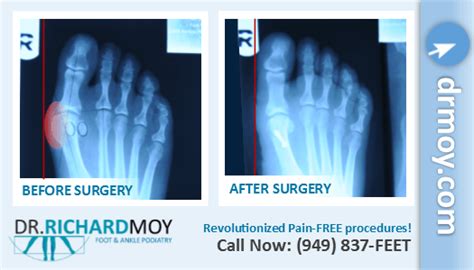 Dr Richard Moy Dpm Painless Bunion Surgery Board Certified Surgeon