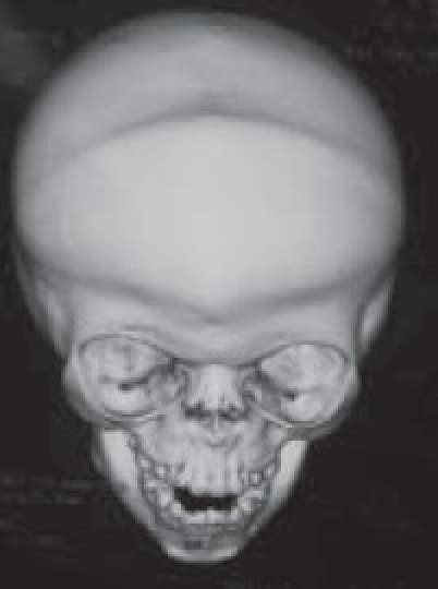 3-D OF CORONAL SUTURES (frontal) | Download Scientific Diagram