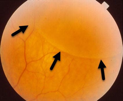 Retinoschisis Treatment Laser