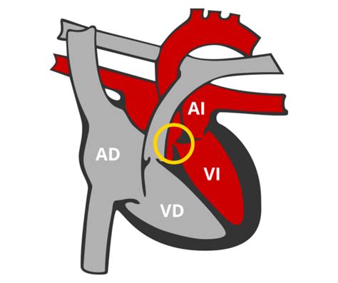 ¿qué Es La Estenosis Aórtica Asociación Corazón Y Vida