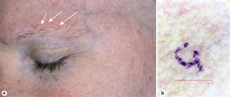 Figure 2 From Erythematous Papules Involving The Eyebrows In A Patient With A History Of Rosacea