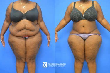 Tummy Tuck Results Overweight