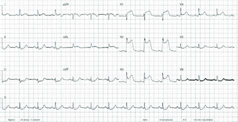 3 Anterior ST-segment-elevation ECG. More marked ST-segment elevation V... | Download Scientific ...