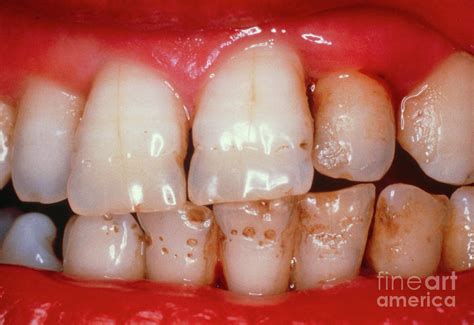 Pitted Teeth Hypoplasia Of The Enamel Photograph By Biophoto