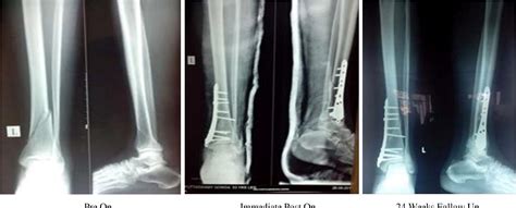 Table 4 From A Study Of Functional Outcome Of Distal Tibial Extra