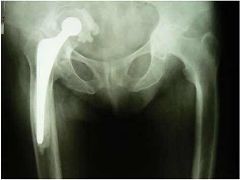 Medicina Free Full Text Revision Hip Arthroplasty In Patient With