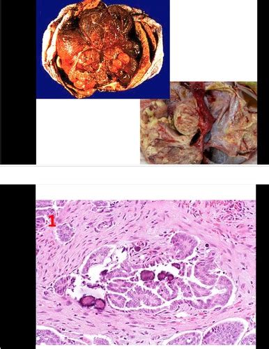 Neoplasias Lab Fotos Flashcards Quizlet