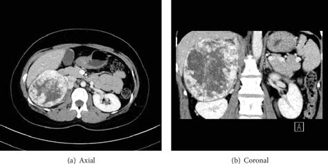 Figure 1 From A Case Of Malignant Pheochromocytoma Detected During Fertility Treatment