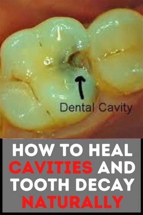 Get Rid Of Cavities And Tooth Decay Emily Smith Artofit