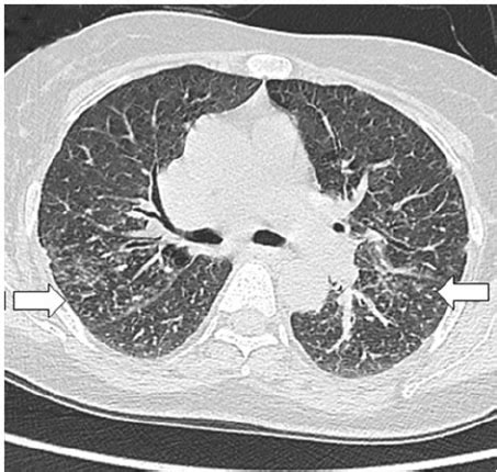 Idiopathic pulmonary fibrosis. High-resolution CT scan showing diffuse ...