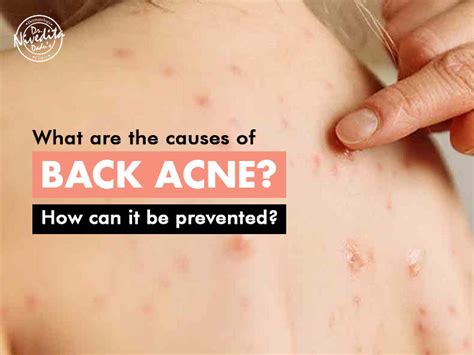 How To Get Rid Of Back Acne Treatments And Causes Be Beautiful India