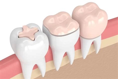 Incrustación Dental Una Solución Estética Clinica Dental Sonrisa Segura