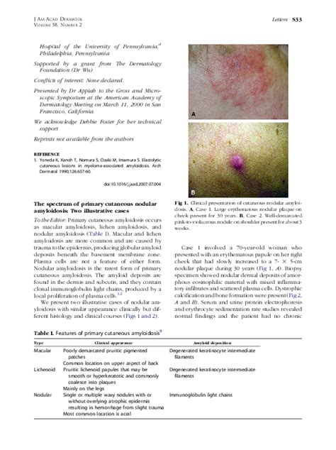 Nodular Amyloidosis