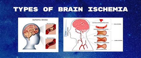 Brain Ischemia Types, Causes and Symptoms - Dr Deepak Agrawal