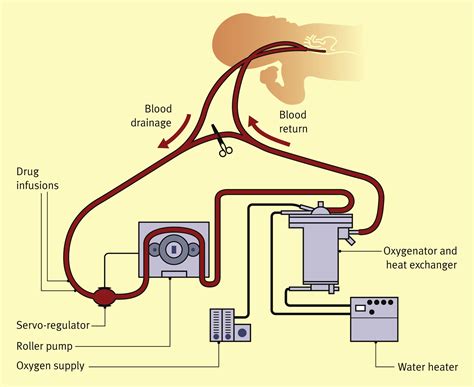 An Overview Of Extracorporeal Membrane Oxygenation Ecmo Paediatrics