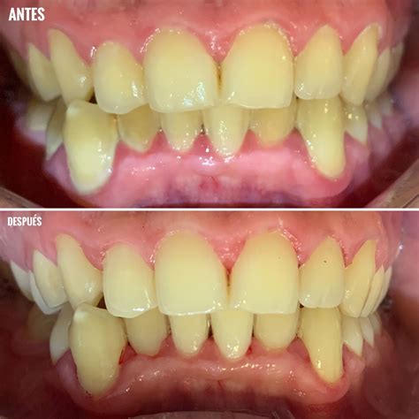 Exclusivo Regi N Catalogar Antes Y Despues De Una Limpieza Dental