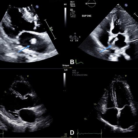 Transthoracic Echocardiogram Showing The Parasternal Long Axis Left