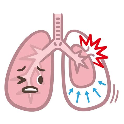 Tension Pneumothorax Vector Art Stock Images Depositphotos