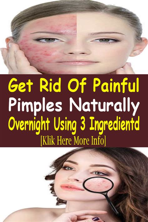 How To Get Rid Of Pimples That Hurt Viralhealth