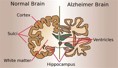 Researchers Suggest A New Treatment Target For Alzheimers Disease